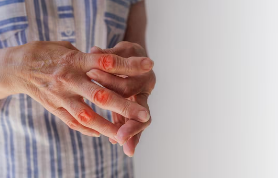 Icon representing Rheumatoid arthritis